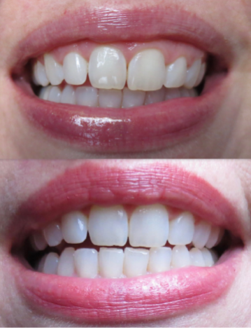Smile Brilliant Before and After Results